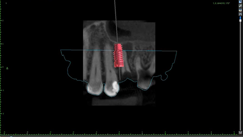All-on-X Dental Implants