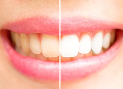 Teeth Whitening